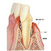 歯周病