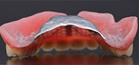 保険外の入れ歯