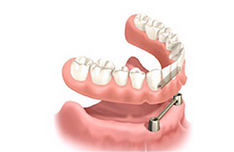 オーバーデンチャー